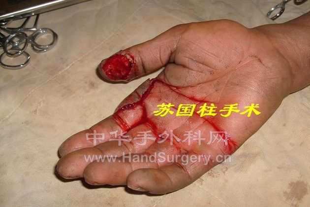 缺损.JPG