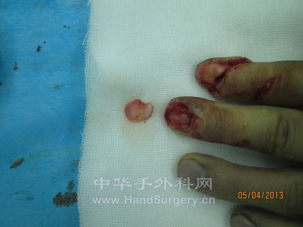 中指甲床撕脱