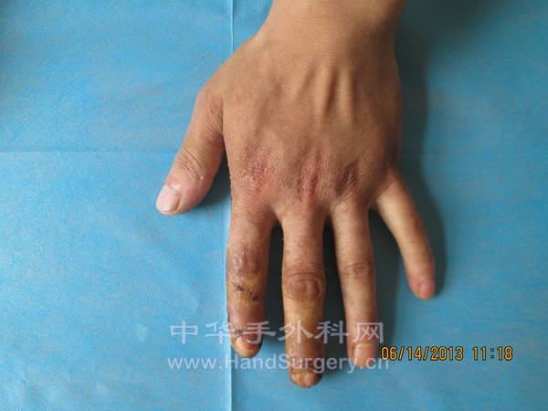 甲床直接原位缝合，打包加压，1周拆包，甲床成活。图为术后1月复查情况。 ...