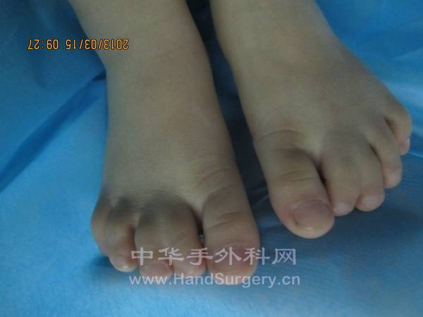 双足二三趾并趾术前