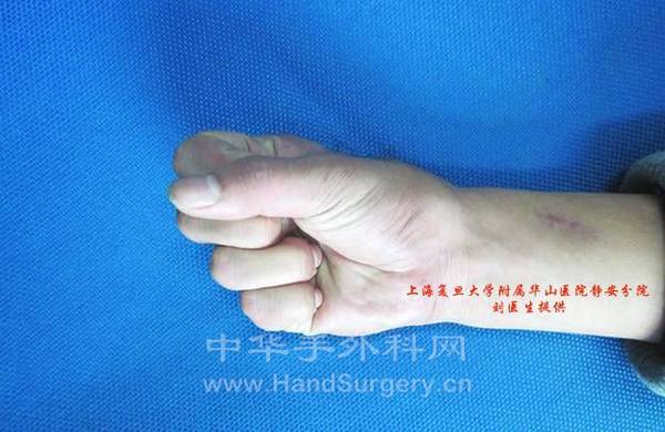 术后随访