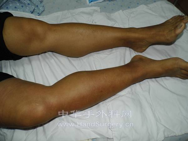 双下肢对比