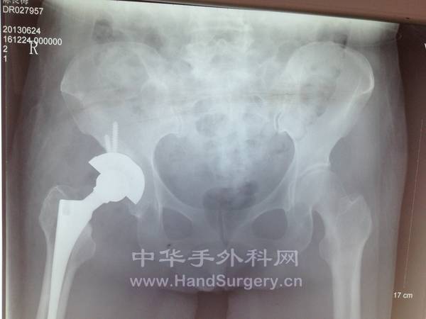 置换术后