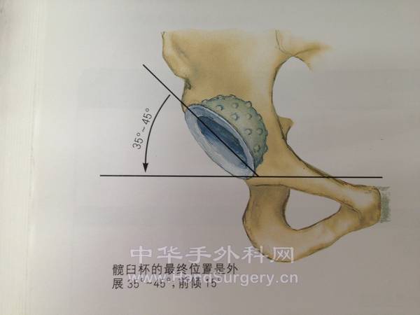 髋臼前倾角