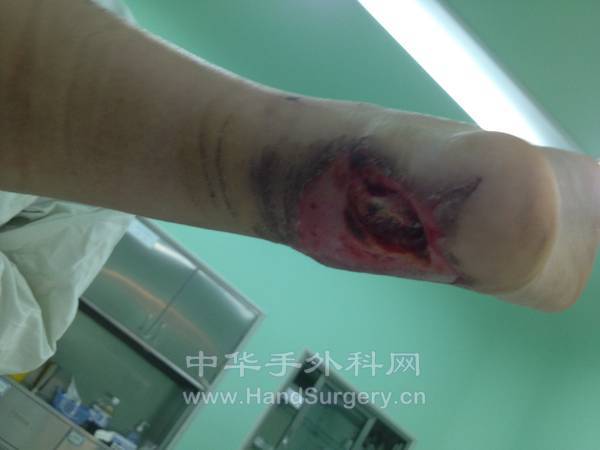 左足跟后组织缺损情况