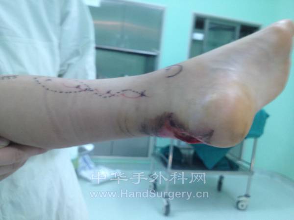 组织缺损情况