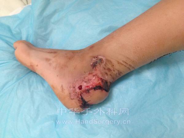 （术后换药）修复术后