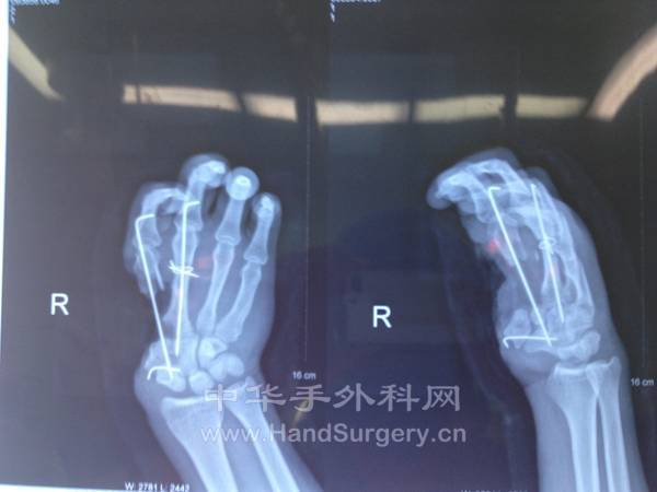右手骨折情况