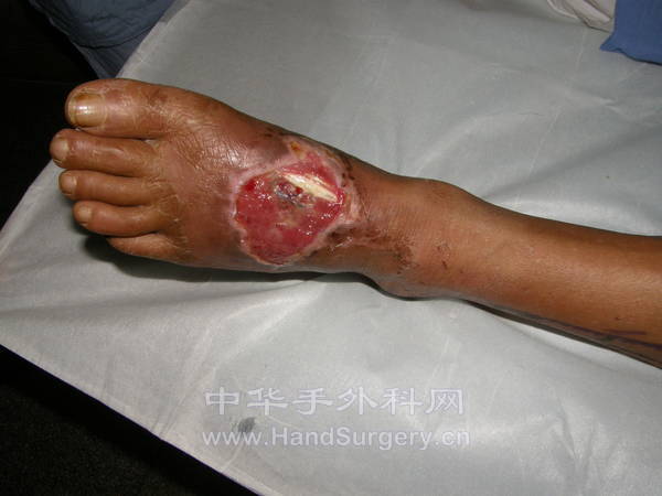 左足背组织缺损肌腱外露