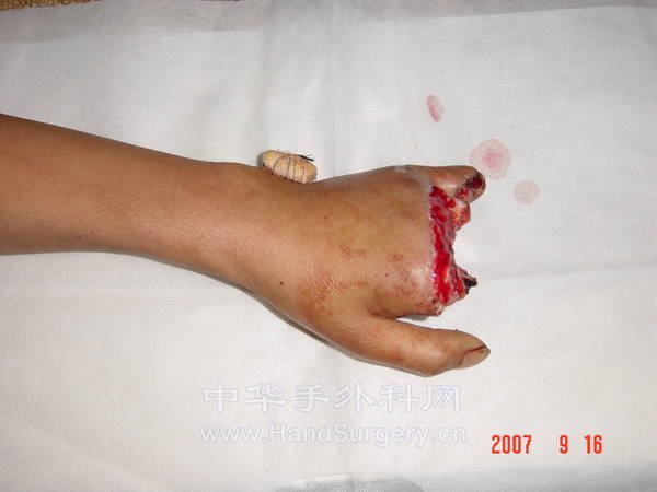 左手毁损伤背侧情况