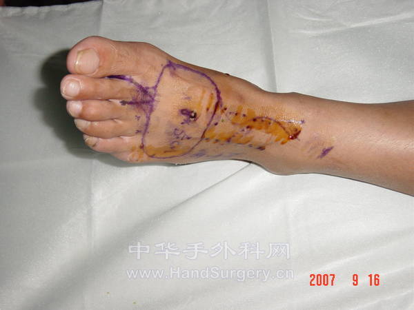 左足第二趾及足背皮瓣设计