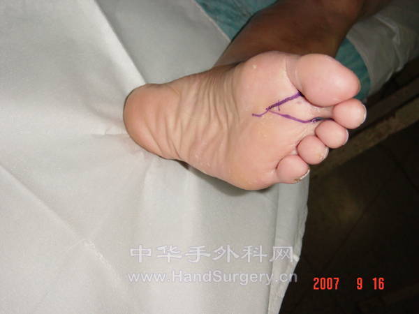 第二趾足底设计情况