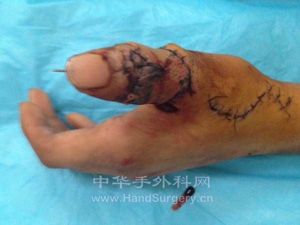 修复术后
