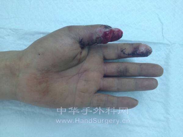 左手拇指末节掌侧组织缺损