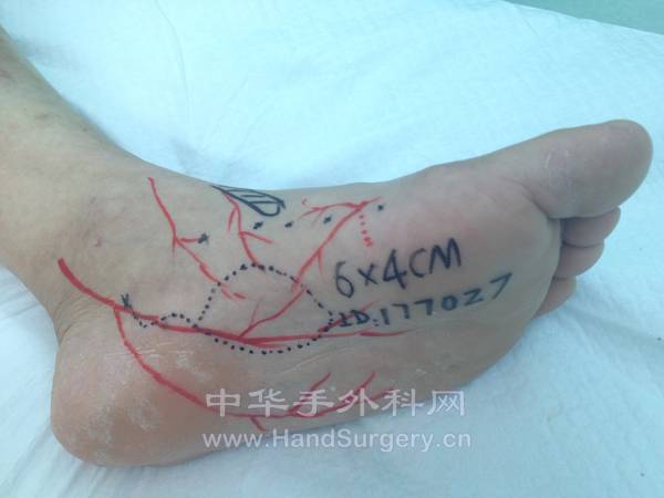 左足底内侧皮瓣设计