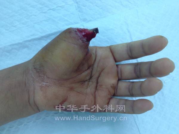左手拇指三度缺损