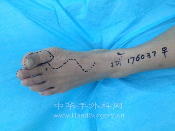 拇甲瓣及第二趾骨关肌腱切取的设计