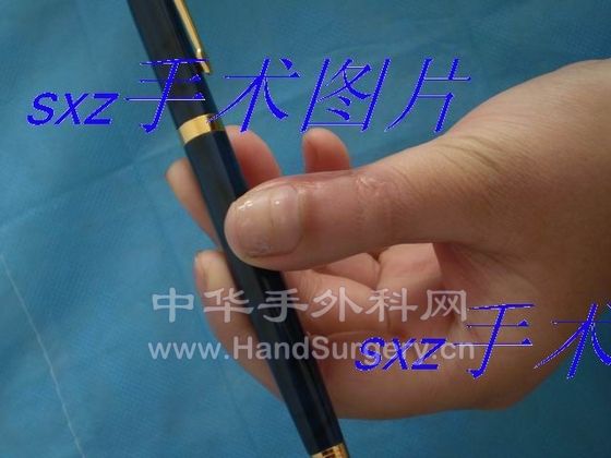 拇指甲瓣1.JPG
