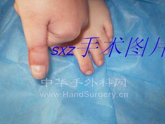 拇指甲瓣2.JPG