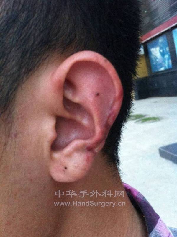 补充随访照片