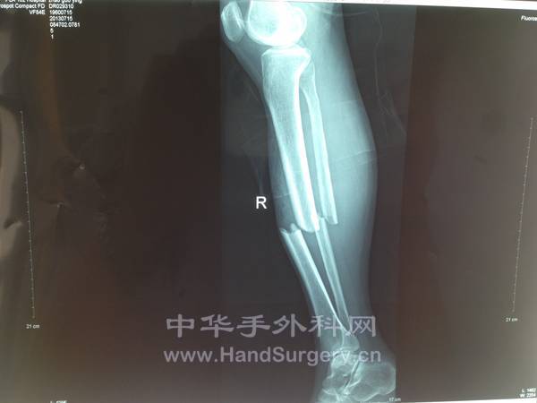 右胫腓骨中段闭合性骨折