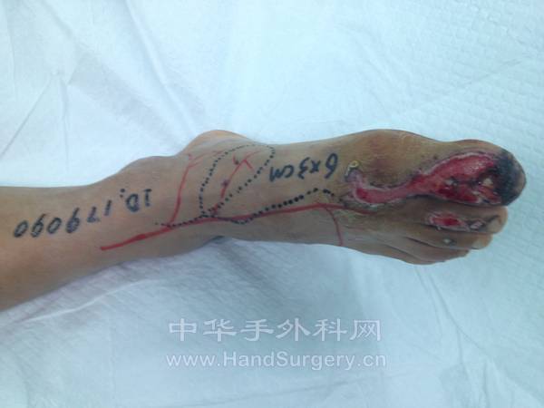 右足拇趾损伤情况及皮瓣设计