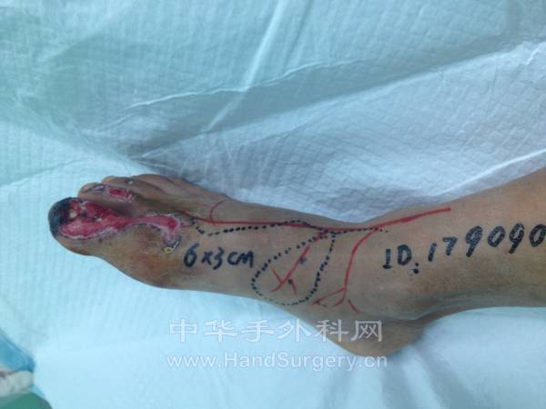 跗内侧皮瓣设计