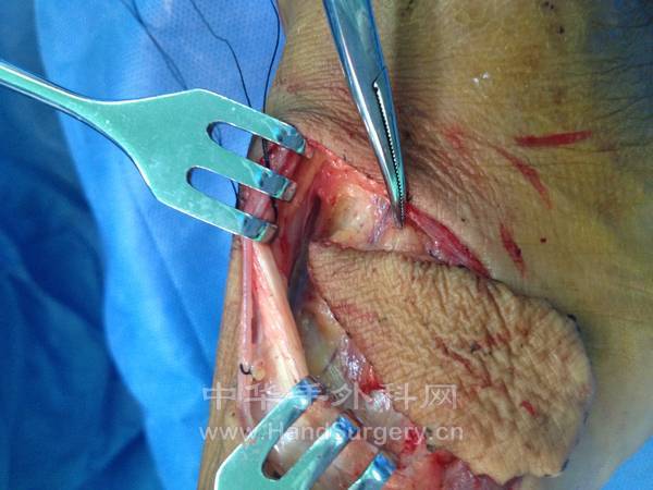 手术显露踝前动脉