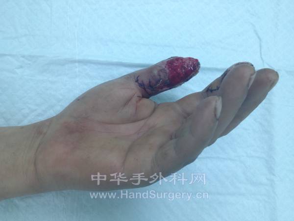左手拇指指腹缺损