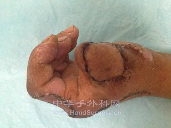 修复术后