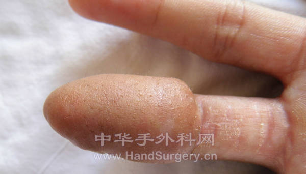 术后一月复查，外形难看，像个蘑菇，择期整形。