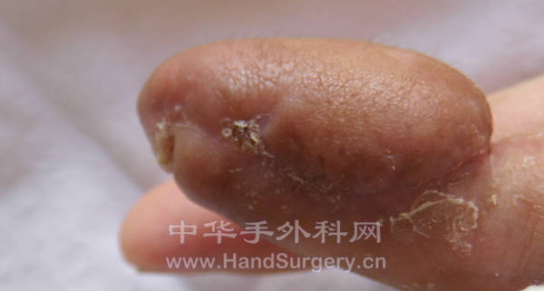 术后一月复查