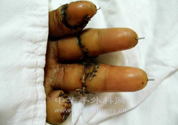 术后第7天