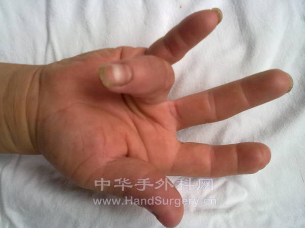 术后3月屈指功能复查