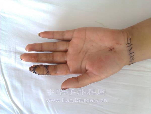 术后一周