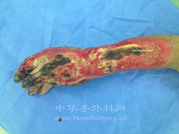 右手拇食指及前臂热压伤清创术后