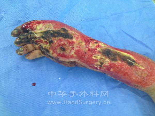 拇食指骨外露前臂伸肌腱部分坏死