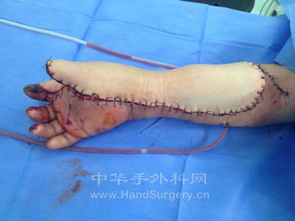 皮瓣修复后