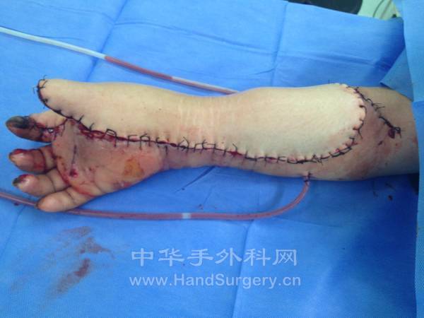 皮瓣修复术后