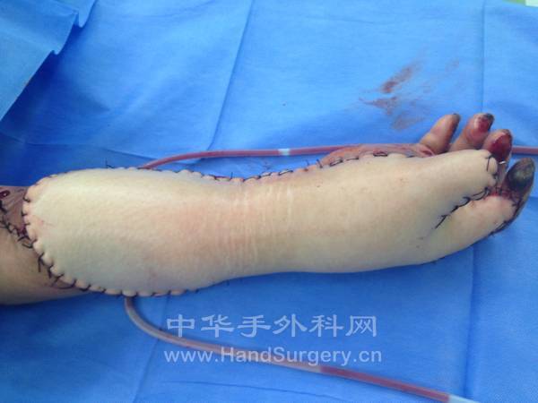 修复术后放置两负压引流球