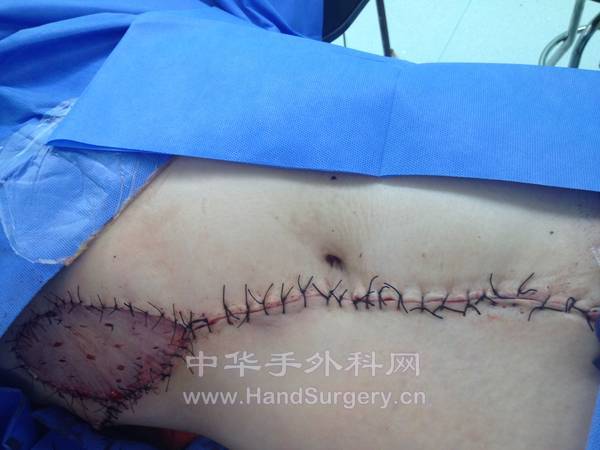 本能直接关闭创面，但关闭后乳房因皮肤张力较高左右不对称，后改对应乳房部位植皮 ... ...
