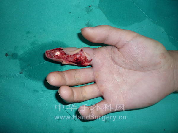食指末节指腹缺损，患者对美观要求较高。