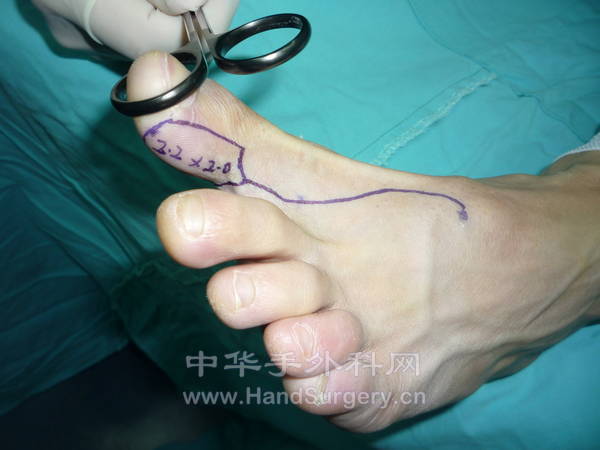 选用同侧踇趾侧腹皮瓣