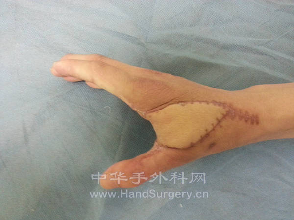 术后随访