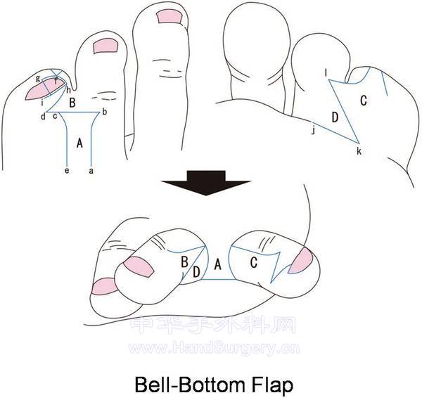 BB-flap设计.jpg