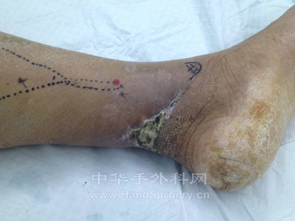左足跟组织坏死