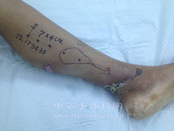  内踝上皮瓣设计