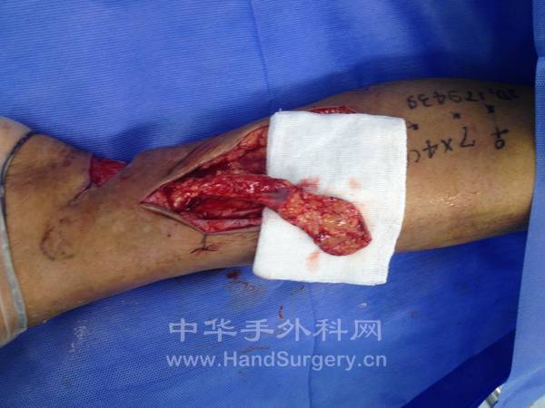 修薄筋膜完成皮瓣的切取