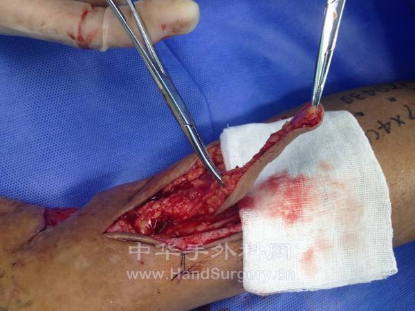 浅筋膜进行部分切取