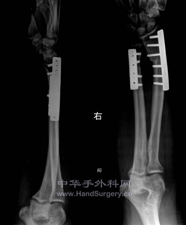 术后一个半月.jpg